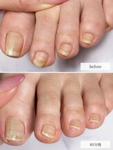 ディグニティ(Dignity)/巻き爪改善ケア(初回→40分後)