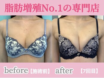 サラエクセレント 天王寺(SARA EXCELLENT)/脂肪が増えて深い谷間に！育乳
