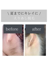 ロカヒ(Lokahi)/えりあし脱毛