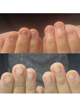 セラキュアネイル(Theracure nail)/自爪育成をスタートされて3ヶ月
