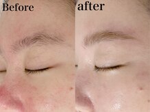 ヒール(heal)/ハリウッドブロウリフト