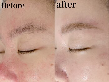 ヒール(heal)/ハリウッドブロウリフト