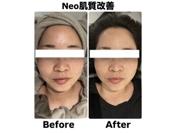 ネオファースト(NeoFirst)/肌質改善【20代女性】
