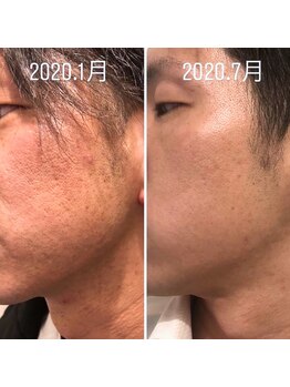 セレブリボーン 大阪ボーテ/美肌脱毛#脱毛#髭脱毛#ヒゲ