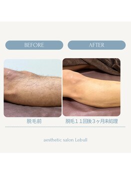 レブル(Lebull)/メンズ脚脱毛