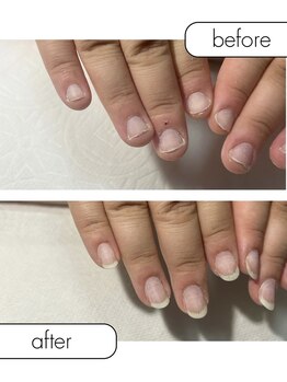 ピノ(pino)/◆深爪矯正自爪の変化◆