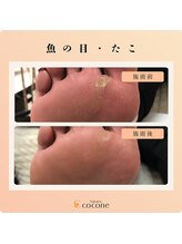 ココネ(cocone)/魚の目・たこ