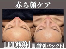 マヴィ くずは店(MavY.)/赤ら顔ケアならコレ！