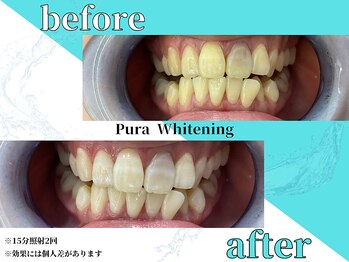 ピュアホワイトニング 横浜店/ホワイトニング/横浜/横浜駅