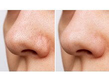 パーフェクトフェイスビューティー 梅田店(PERFECT FACE BEAUTY)/毛穴改善/洗浄
