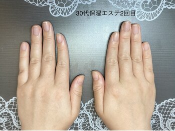 桃の木 吉祥寺店/30代保湿コース後のしっとり手