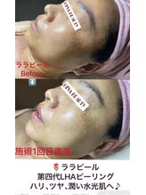 ジナ ビューティ(GINA BEAUTY)/ララピール（韓国肌管理）