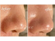 グレイス/頑固な毛穴汚れ、角栓に