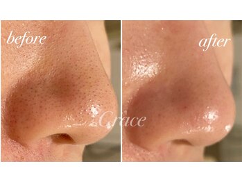 グレイス/頑固な毛穴汚れ、角栓に
