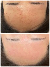 ラヴィ(Ravi)/繰り返すニキビケア