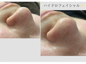 エクラ(ECLAT)/ハイドロフェイシャル
