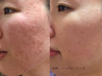 ボタニック 福津店(BoTANiC)/【ハーブピーリング】3回/30代