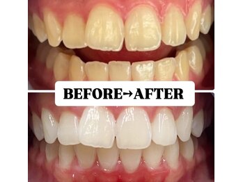 ホワイトニングサロン 豊中/Before&After美白ホワイトニング