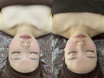 エスプレッソ(espresso,)/衝撃変化の【小顔コルギ】3回