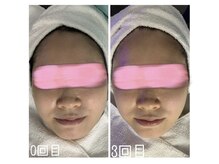 エクスクラメーションマーク(!!!)/超音波リフトアップ