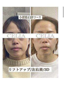 セリア(CELIA)/小顔矯正で垢抜ける