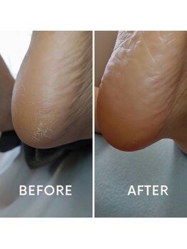 ワイグレイス(Y.GRACE)/フットケア《角質ケア》