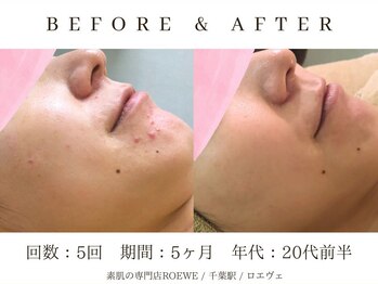 ロエヴェ(ROEWE)/ニキビ改善・毛穴ケア・肌質改善