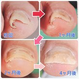 巻き爪ケアセンター 横須賀