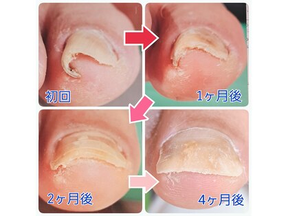巻き爪ケアセンター 横須賀の写真