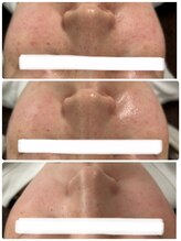 サロン カレア(Salon Kalea)/ハーブピーリング3回目！！