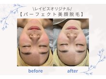 エステティック レイビス 池袋店(RAYVIS)/美顔脱毛