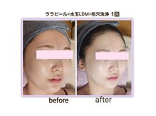 セレブリティ(Celebrity)の雰囲気（ララピール 肌バリアを守り 毛穴・皮脂を整え、自然なツヤ水光肌）