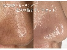 フジモトサロン 那覇おもろまち店(fujimotoサロン)/那覇 毛穴洗浄、毛穴開き改善