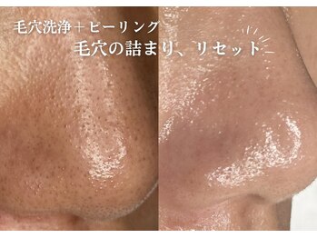 フジモトサロン 那覇おもろまち店(fujimotoサロン)/那覇 毛穴洗浄、毛穴開き改善