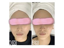 エクスクラメーションマーク(!!!)/超音波リフトアップ