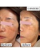 ロミエール 南草津店(LOMIERE)/セルマン★肌質革命！