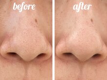 ホワイト ターコイズ/定期的なケアで詰まらせない肌へ