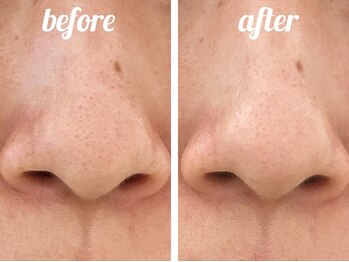 ホワイト ターコイズ/定期的なケアで詰まらせない肌へ