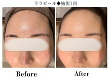 フレイヤ(FREYA)/ララピールBefore→After