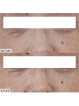 ヴェルシック(Belchic)/オーダーメイドのたるみ改善