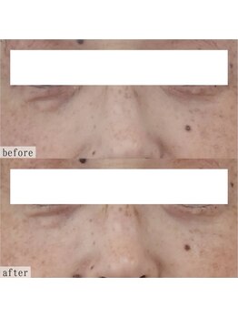 ヴェルシック(Belchic)/オーダーメイドのたるみ改善