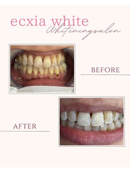 エクシアホワイトニング 倉敷店/ホワイトニングビフォーアフター