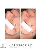 アクシア ビューティー サロン(AXSIA)/【ハイドラ】BeforeAfter