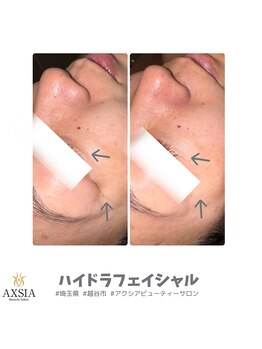 アクシア ビューティー サロン(AXSIA)/【ハイドラ】BeforeAfter