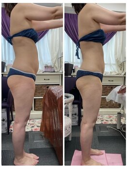 痩身専門サロン ラシュエット(La Chouette)/レモンボトルお腹4回の結果