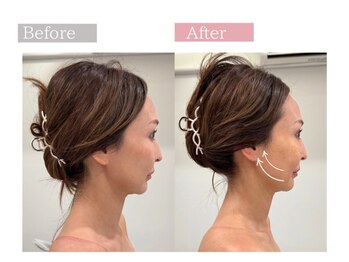 フロリール アザブジュウバン(FlorirAzabujuban)/35歳からの本格小顔&リフト