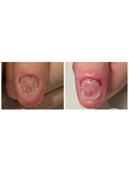 ティアラネイル 宇都宮/深爪矯正