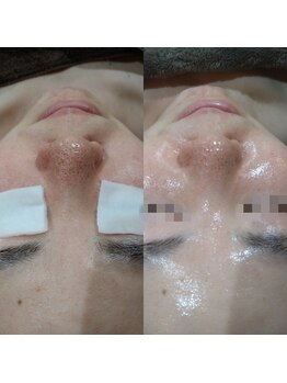 ボーソリューション(Beau-Solution)/【20代　開き毛穴/黒ずみ毛穴】