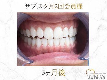 ホワイヤ セルフホワイトニング DBS神楽坂(Whi-Ya)/☆サブスク会員様☆納得の白さ☆