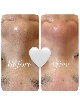 ユニ(uni.)/毛穴エクストラクション